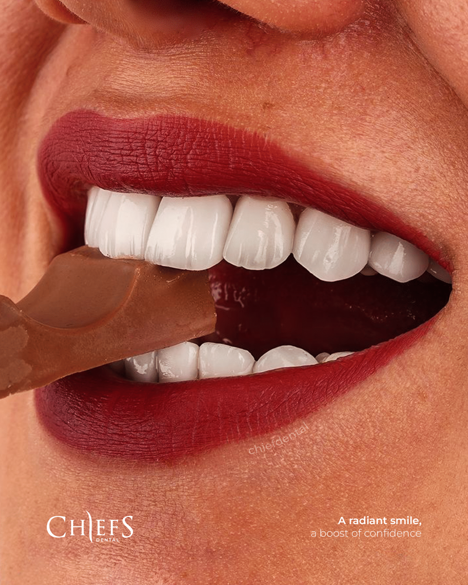 Dental Implants in Turkey