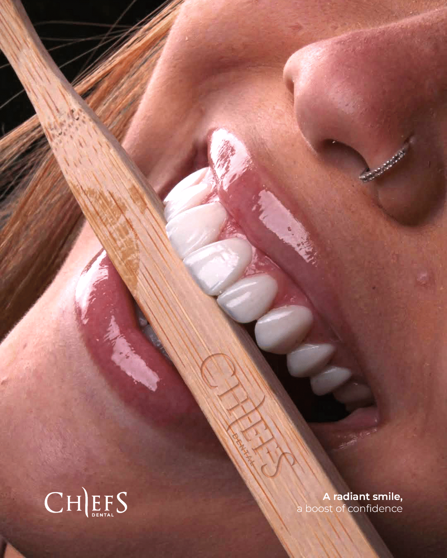 E-MAX Crowns in Turkey