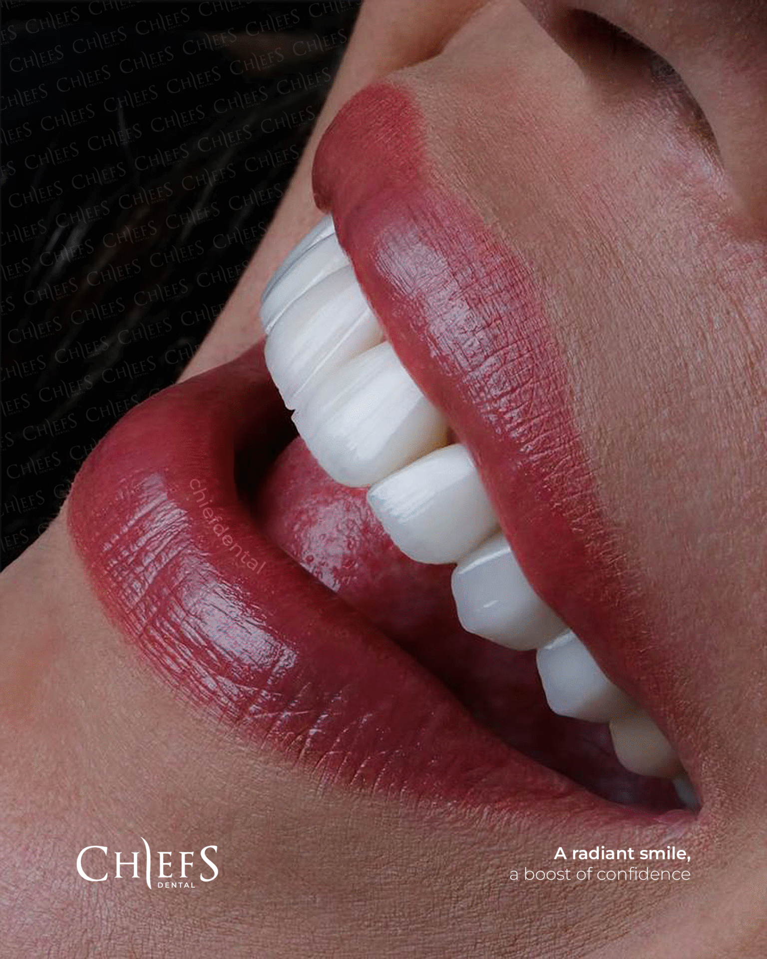 Hollywood Smile in Turkey