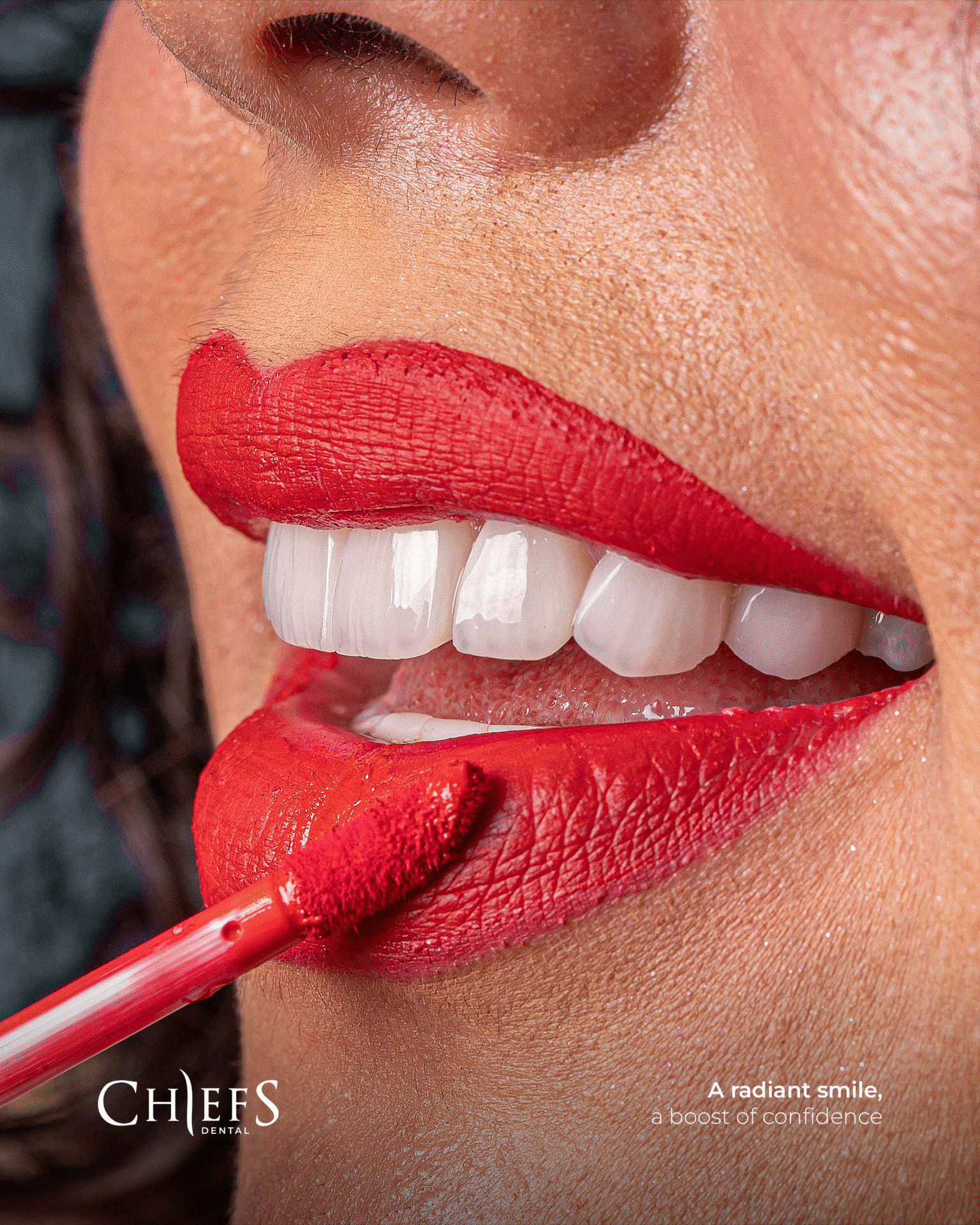 Laminate Veneers in Turkey